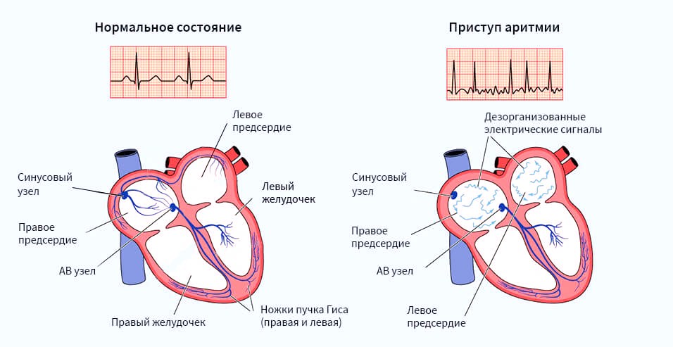 аритмии