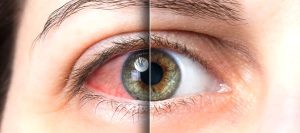 Покраснел и воспалился глаз