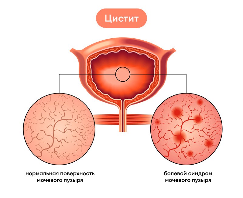 цистит