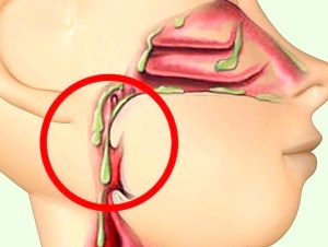 Слизь в носоглотке, как избавиться