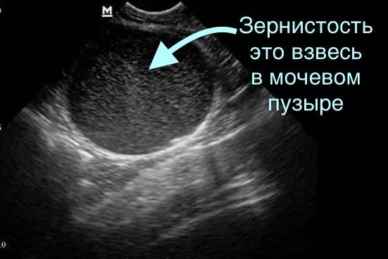 взвесь в мочевом пузыре