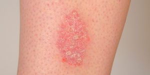 Шершавые участки кожи на ногах у ребенка