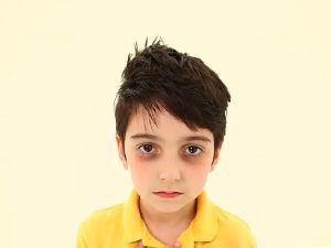 Темные круги под глазами у ребенка