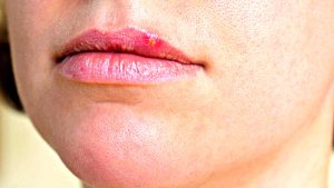 Частый герпес на губах, как избавиться?