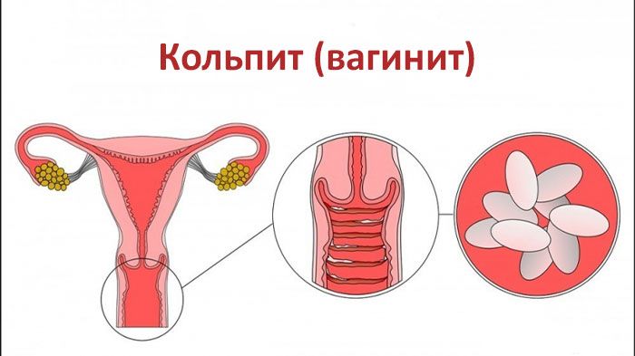 кольпит при беременности