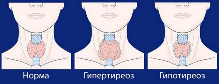щитовидная железа болезни