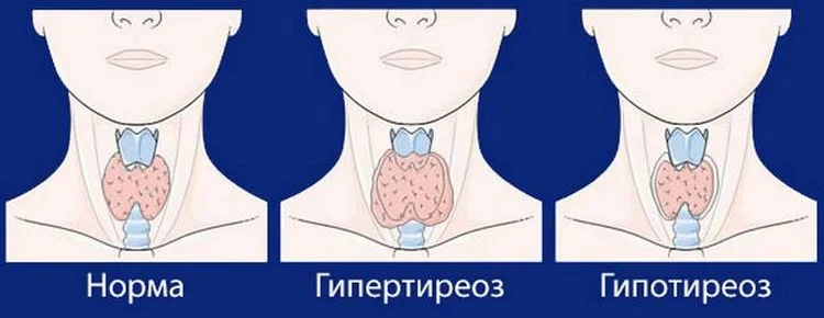 щитовидная железа болезни