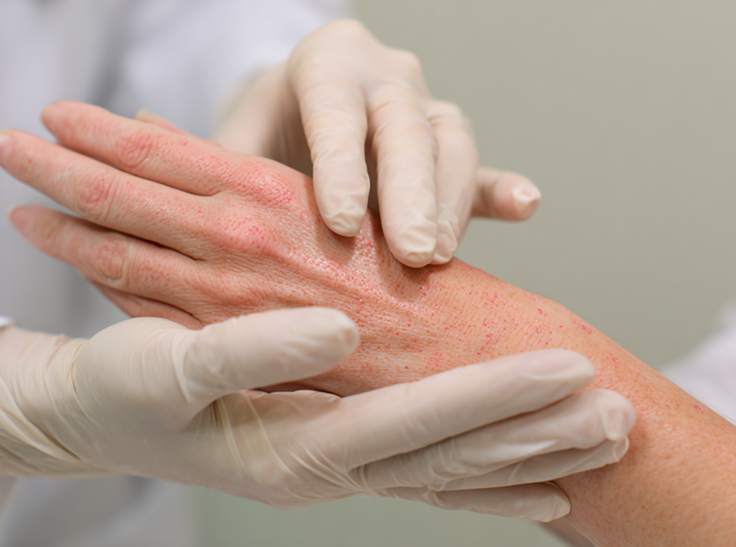 Дисгидроз (помфоликс): симптомы, диагностика и лечение заболевания