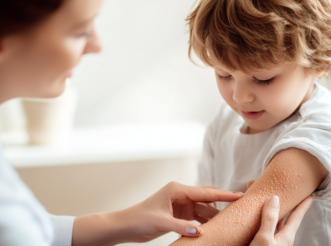 Контагиозный моллюск у детей лечение