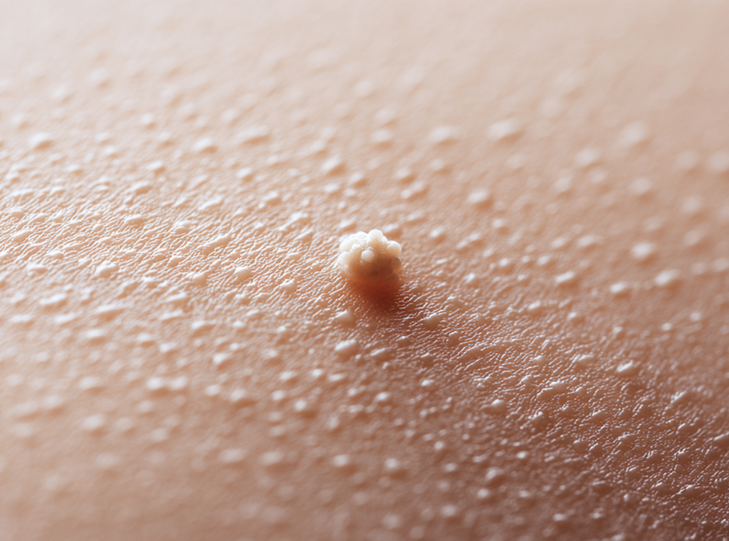 Папиллома: виды, причины, симптомы и лечение