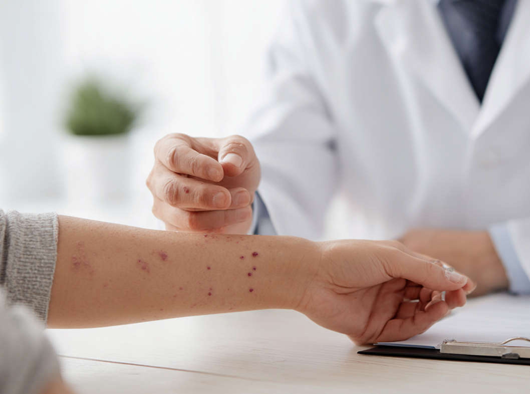 Кератома Лечение